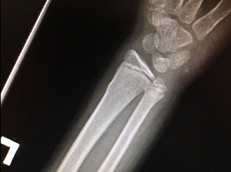 buckle fracture xray